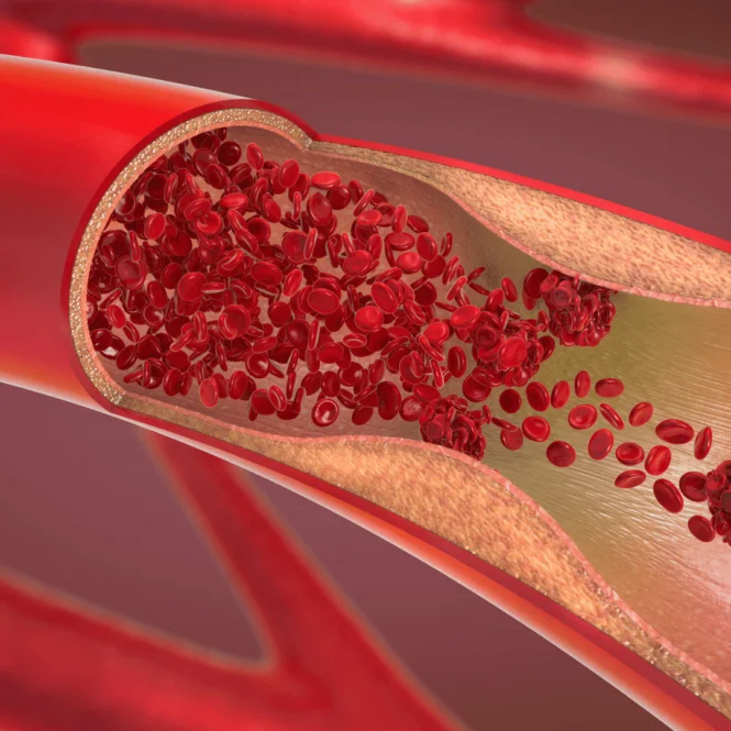 Thrombosis and the menopause
